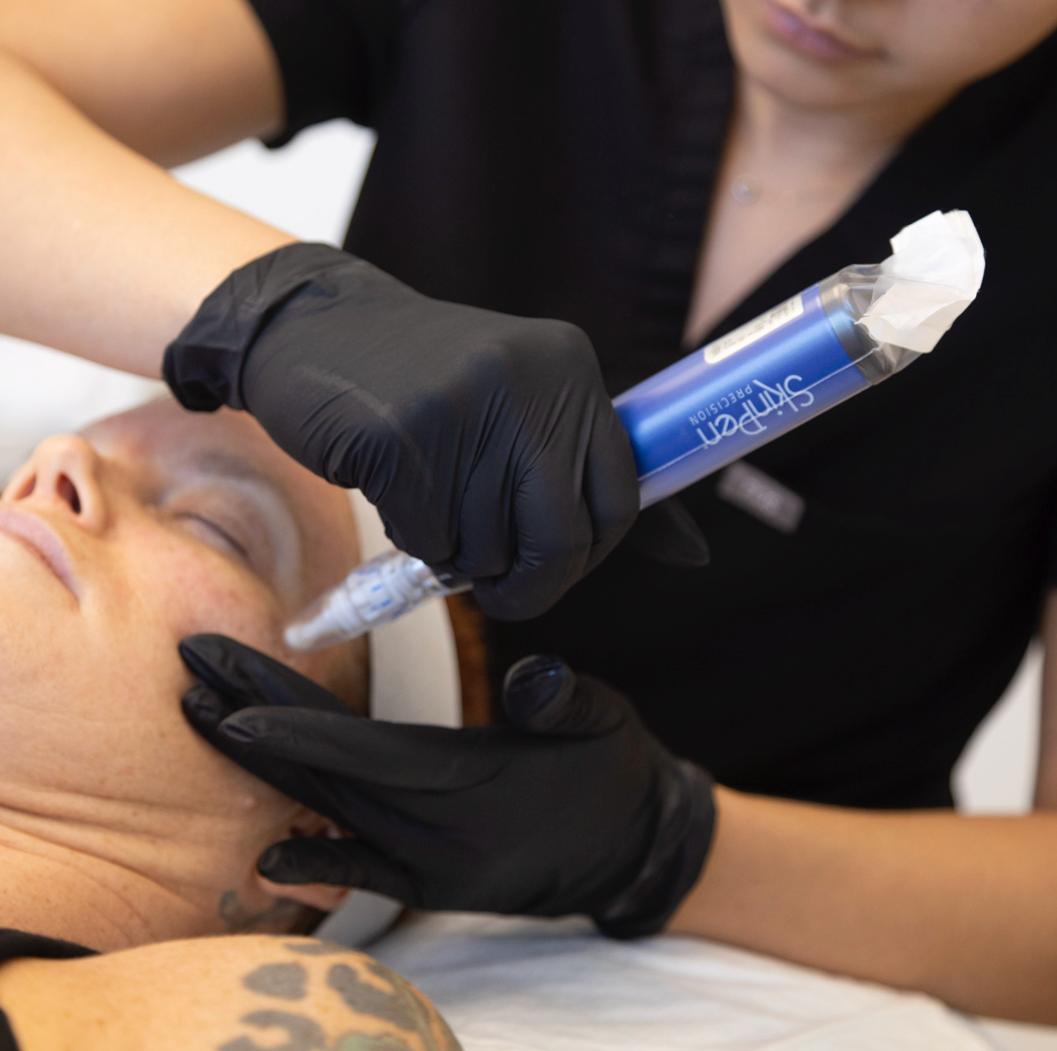 Woman Laying down receiving SkinPen Microneedling Treatment