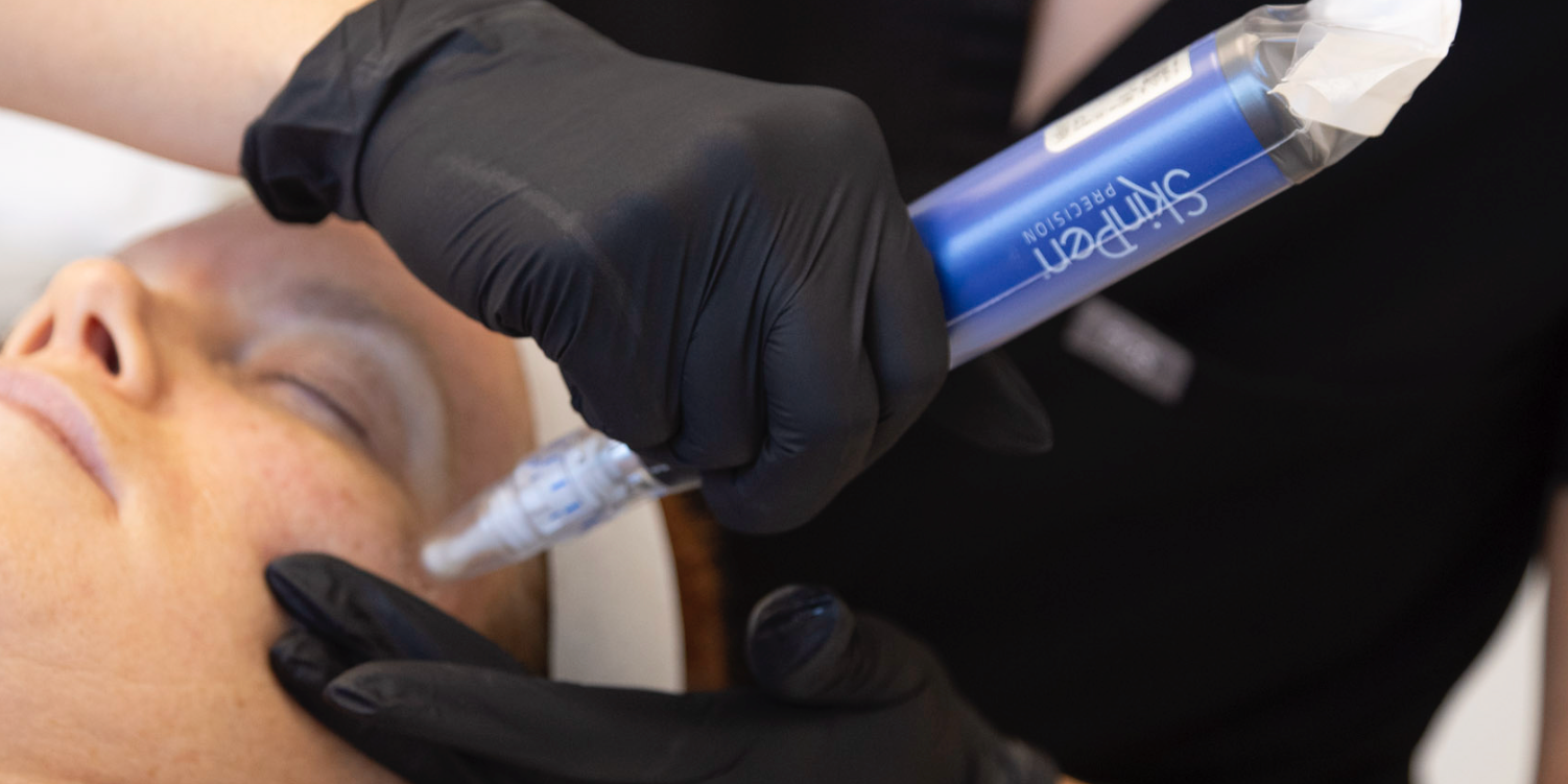 Woman Laying down receiving SkinPen Microneedling Treatment