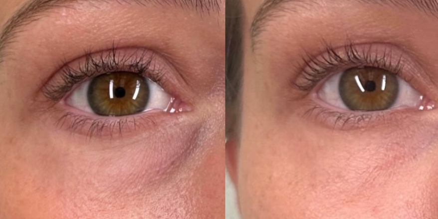 Revitalize Your Eyes with Tear Trough Filler and PRP at Aloha Med Spa, Kaua’i