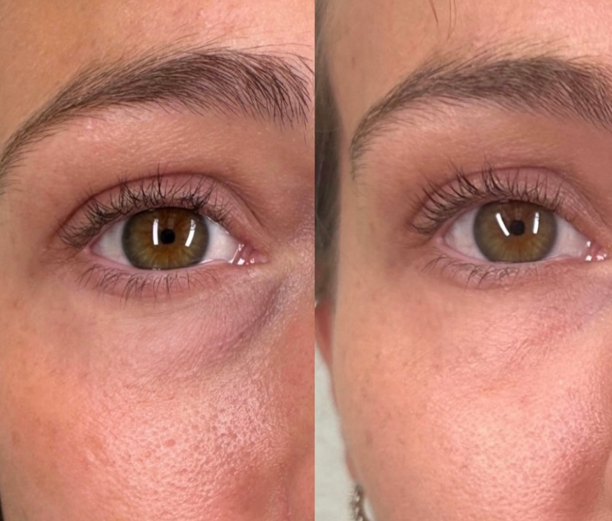 Revitalize Your Eyes with Tear Trough Filler and PRP at Aloha Med Spa, Kaua’i