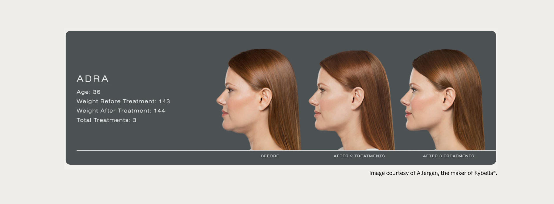 Kybella Fat Dissolver