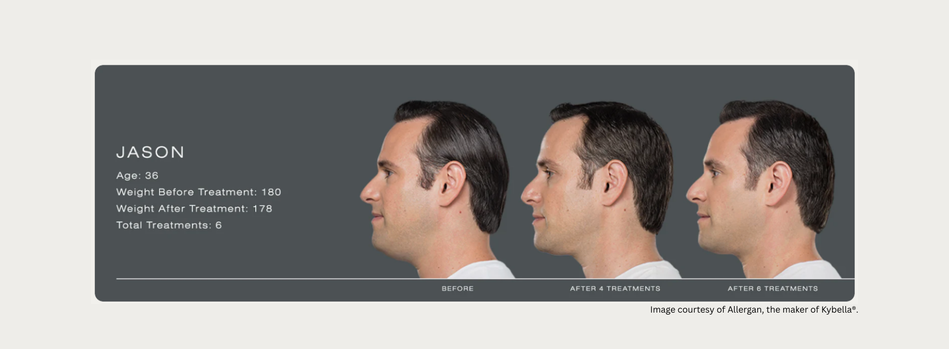 Kybella Fat Dissolver