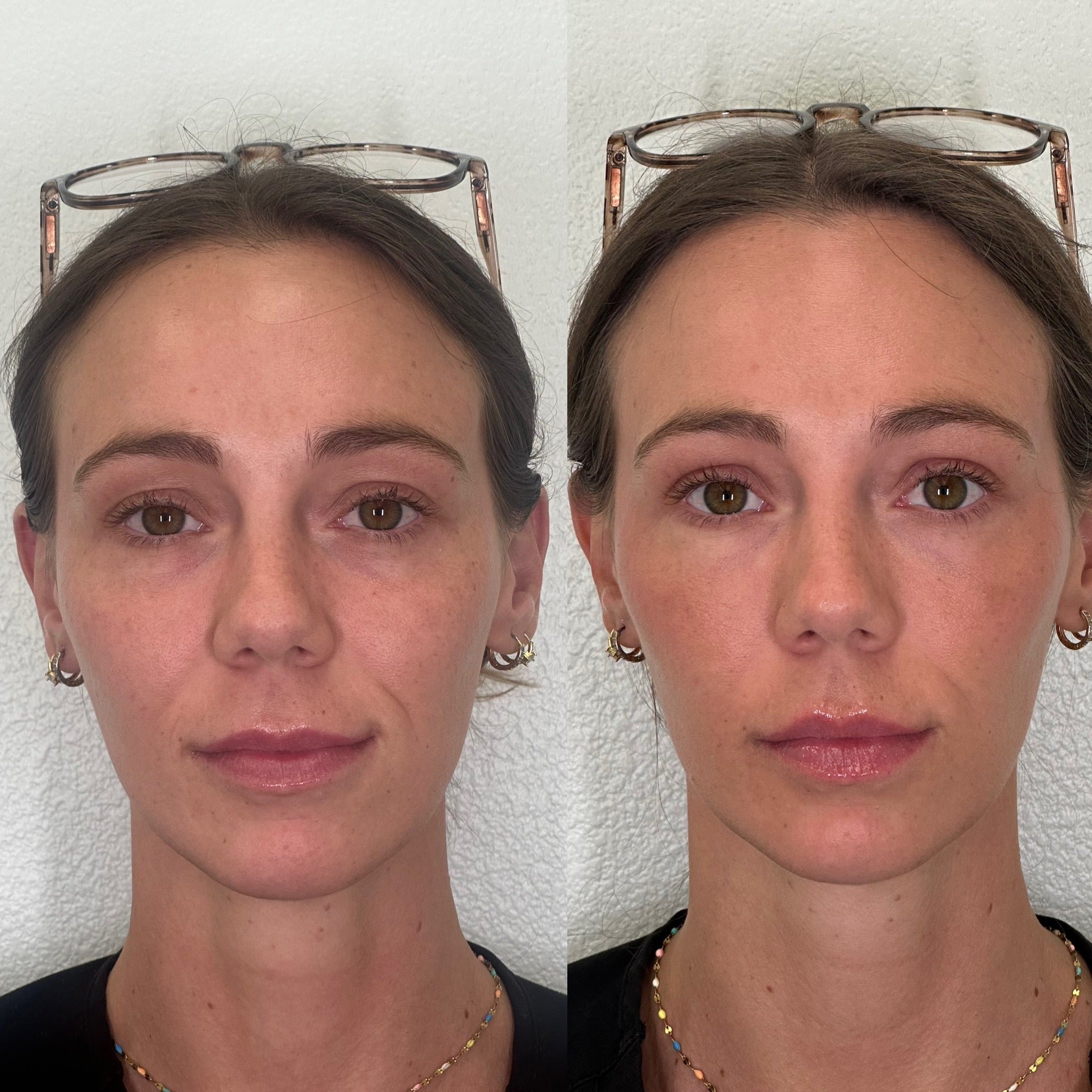 Ariessence Platelet-Derived Growth Factor (PDGF+)