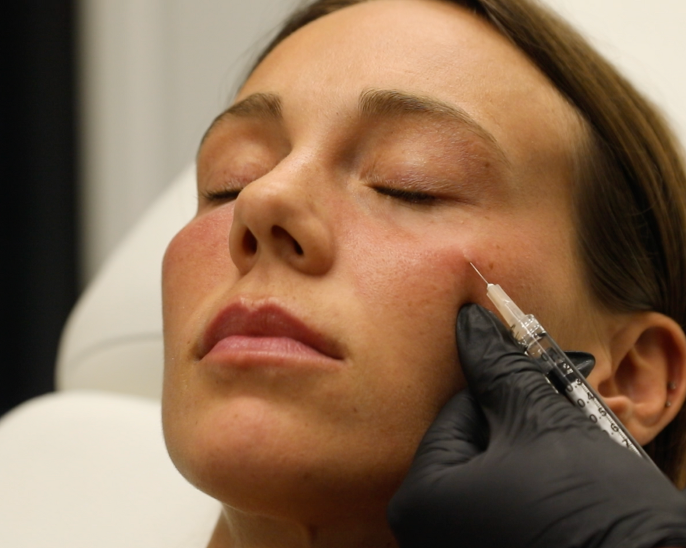 Tear Trough Filler with PRP