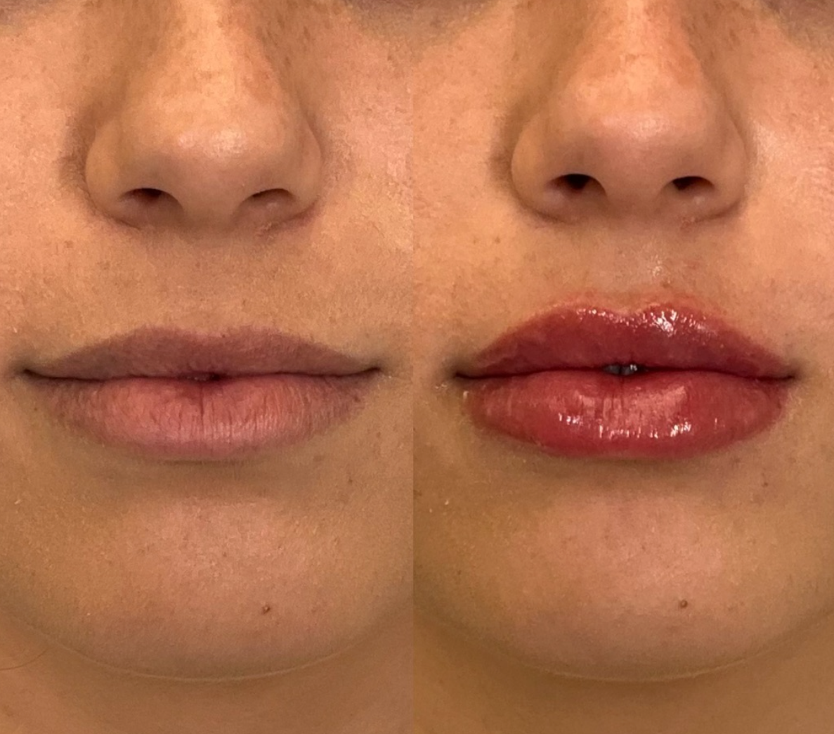 Lip Filler