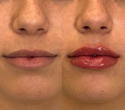 Lip Filler