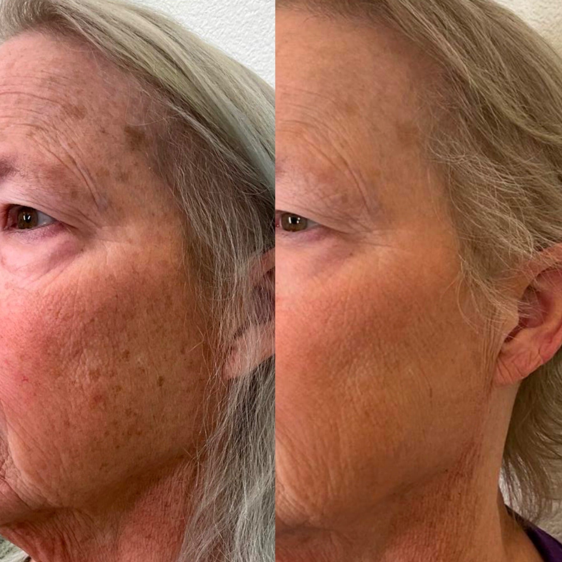 IPL (Intense Pulsed Light)