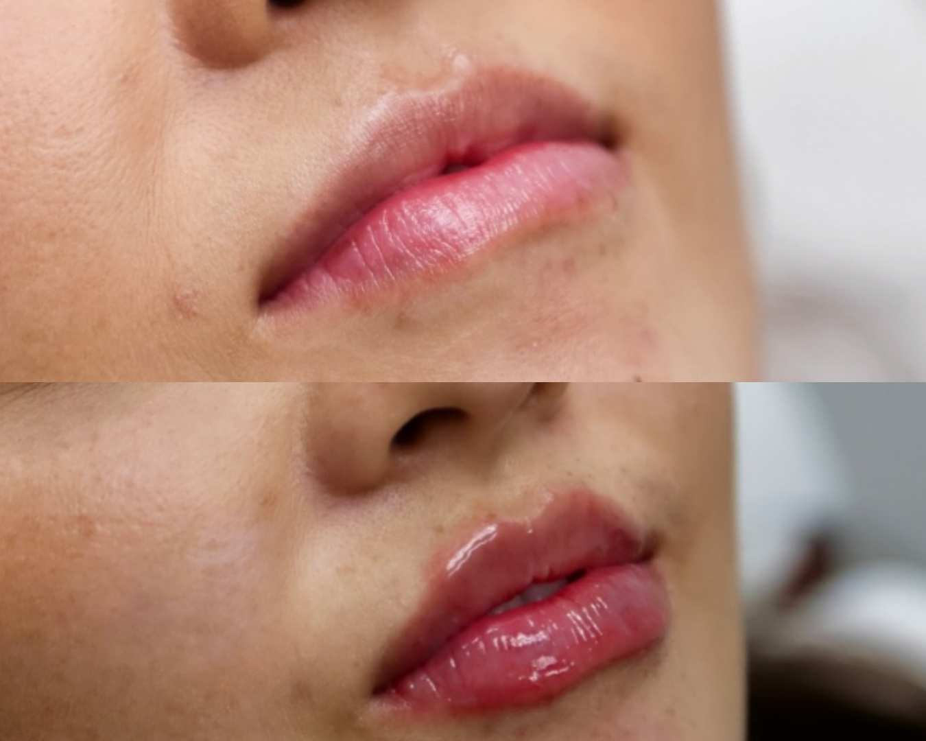 AlohaMedSpa-LipFiller.png