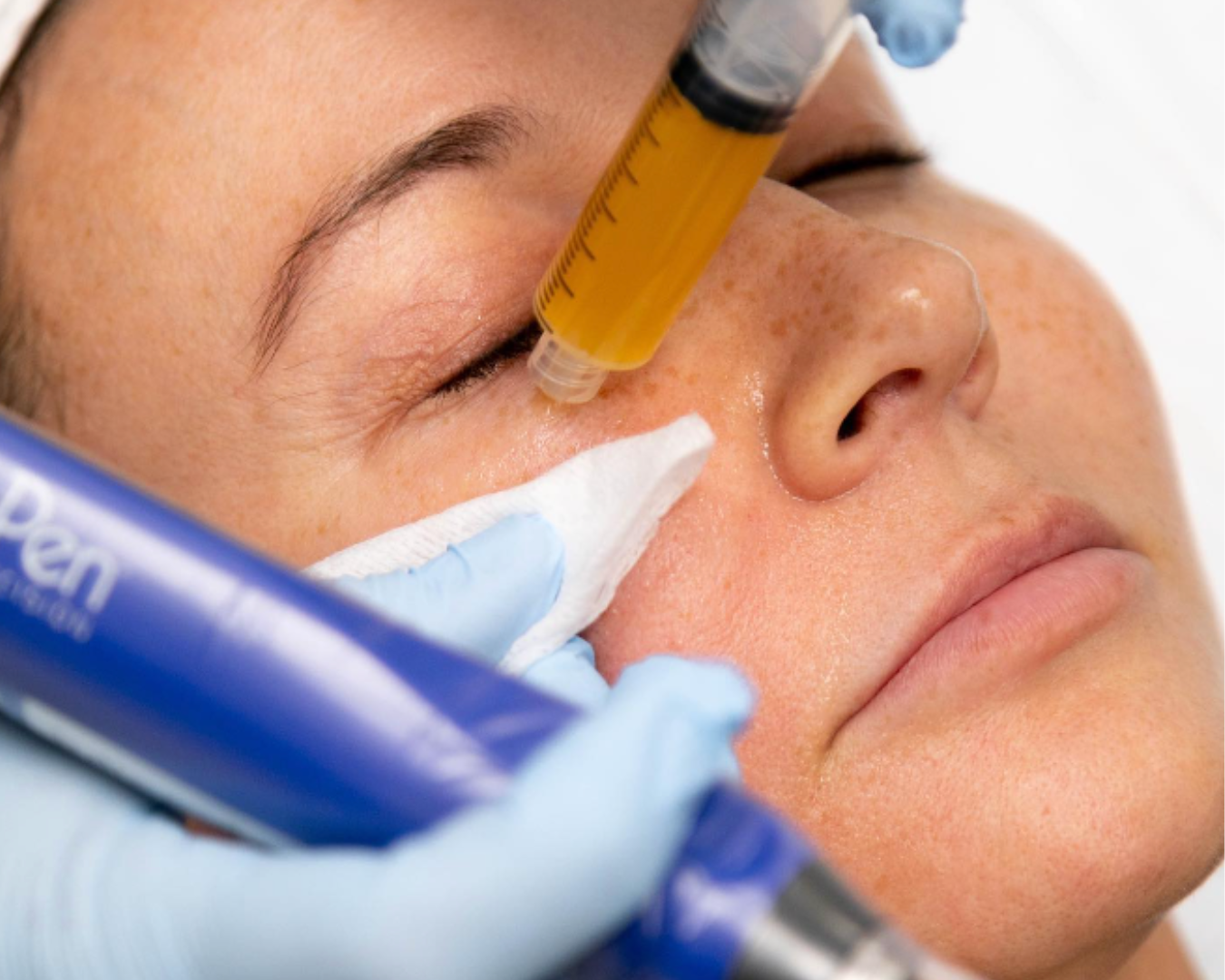 Aloha_Med_Spa_-_SkinPen_with_PRP_790d5e78-2519-4c5b-a397-2ce56cca313e.png