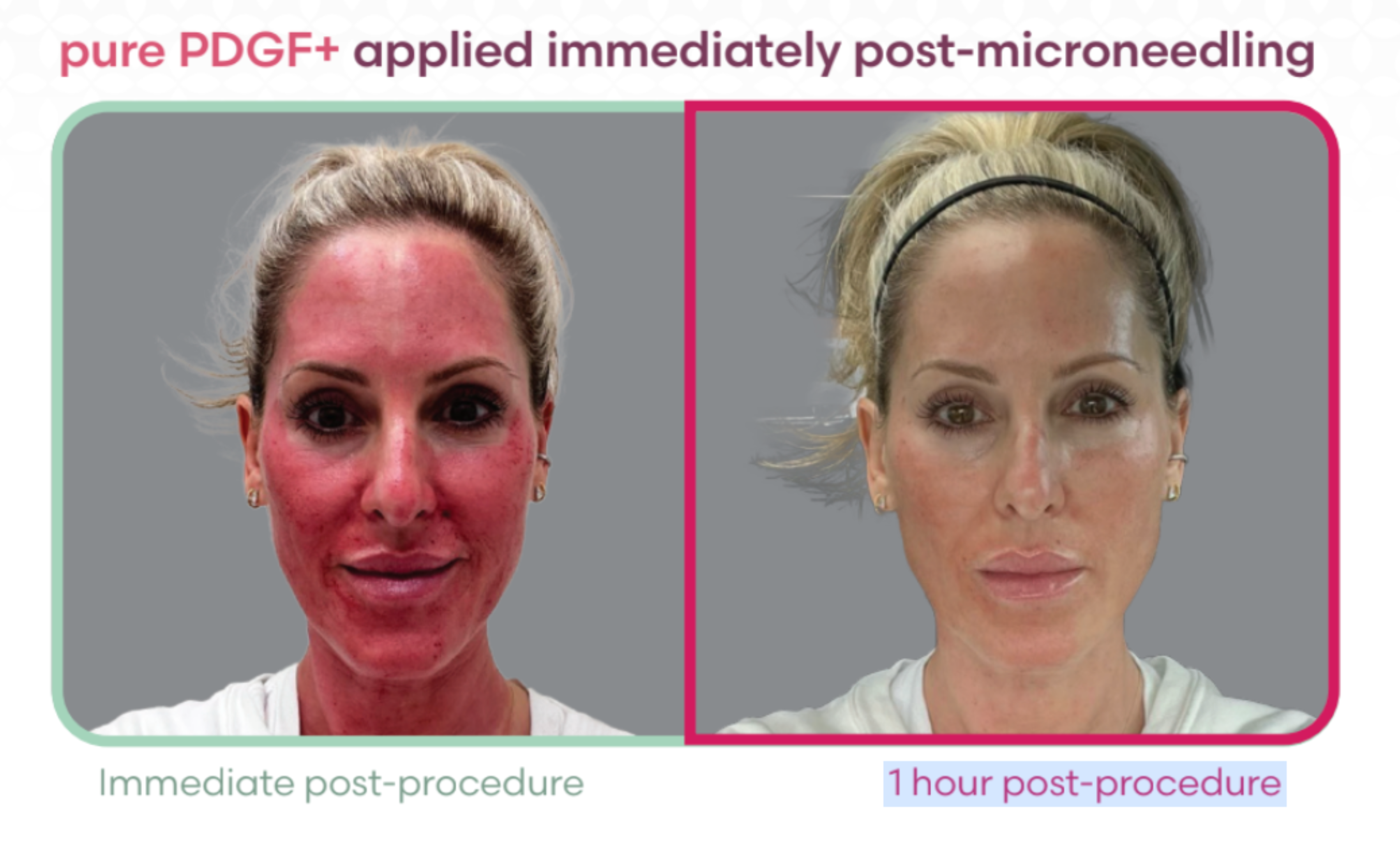 Ariessence Platelet-Derived Growth Factor (PDGF+)