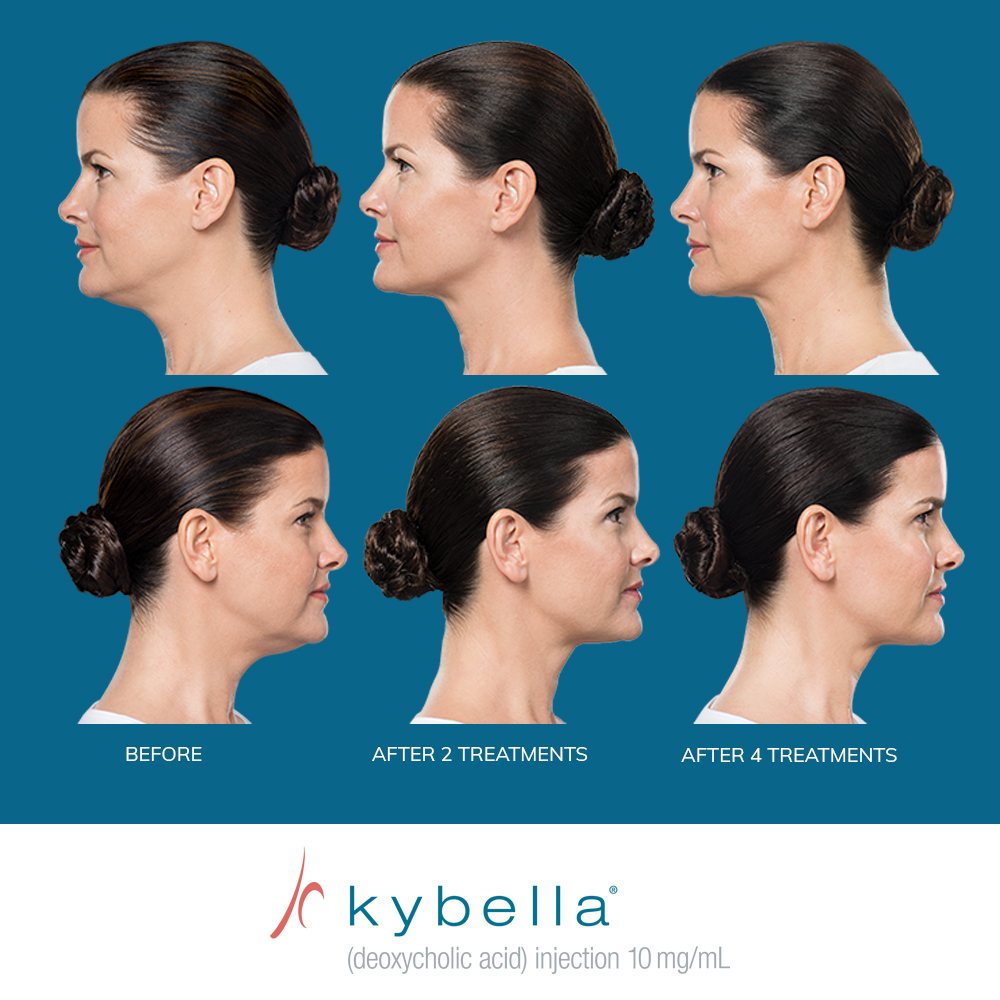 Kybella Fat Dissolver  Aloha Med Spa